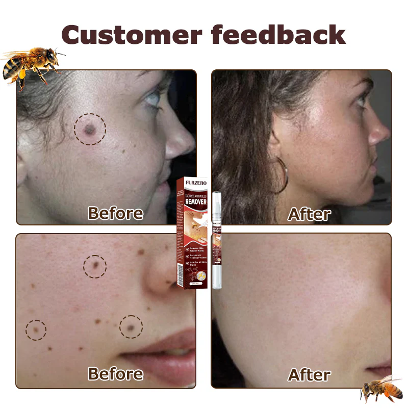 Furzero™ TagFree And Moles Remover