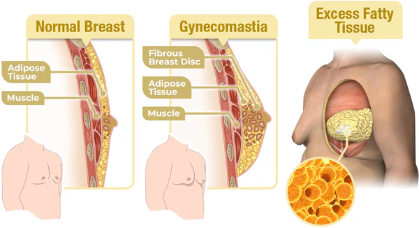 GFOUK™ MenTherm Bee Venom Gynecomastia Heating Oil