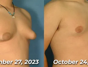 GFOUK™ MenTherm Bee Venom Gynecomastia Heating Oil