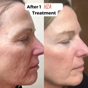 HZA™ Micro Infusion System