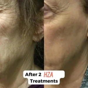 HZA™ Micro Infusion System