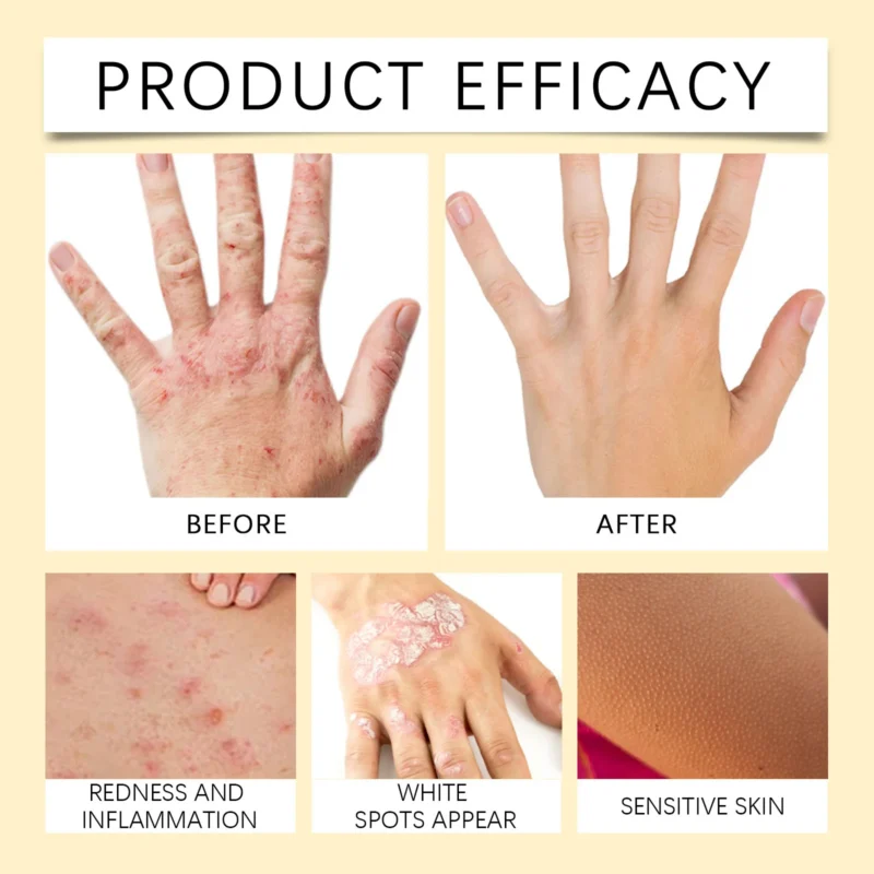 Histone™ VitiGO Bee Venom Treatment Cream