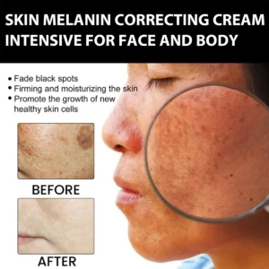 Hudros® Acanthosis Nigricans Therapy