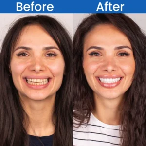 LIMETOW™ Teeth Stain Remover