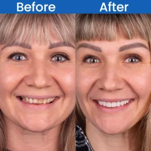 LIMETOW™ Teeth Stain Remover