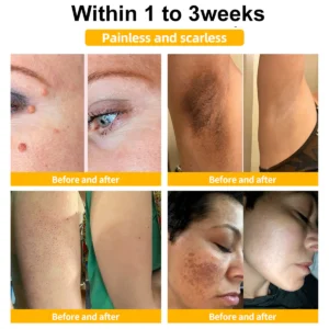 LOVILDS™ Bee Venom Mole and Wart Treatment Cream