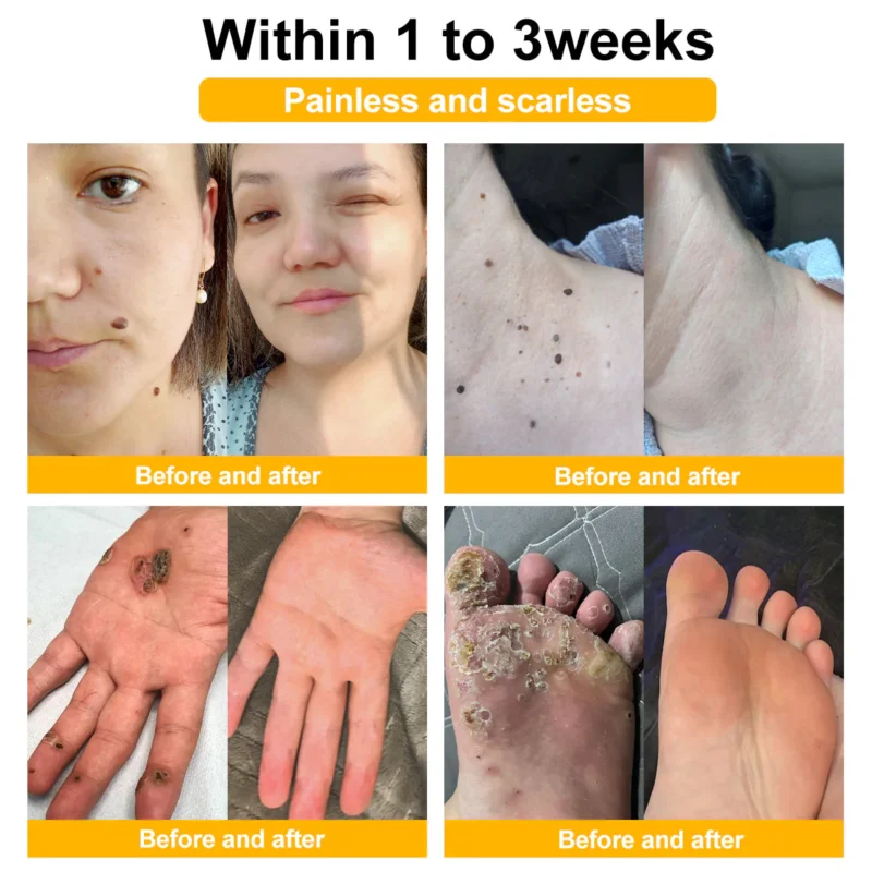LOVILDS™ Bee Venom Mole and Wart Treatment Cream