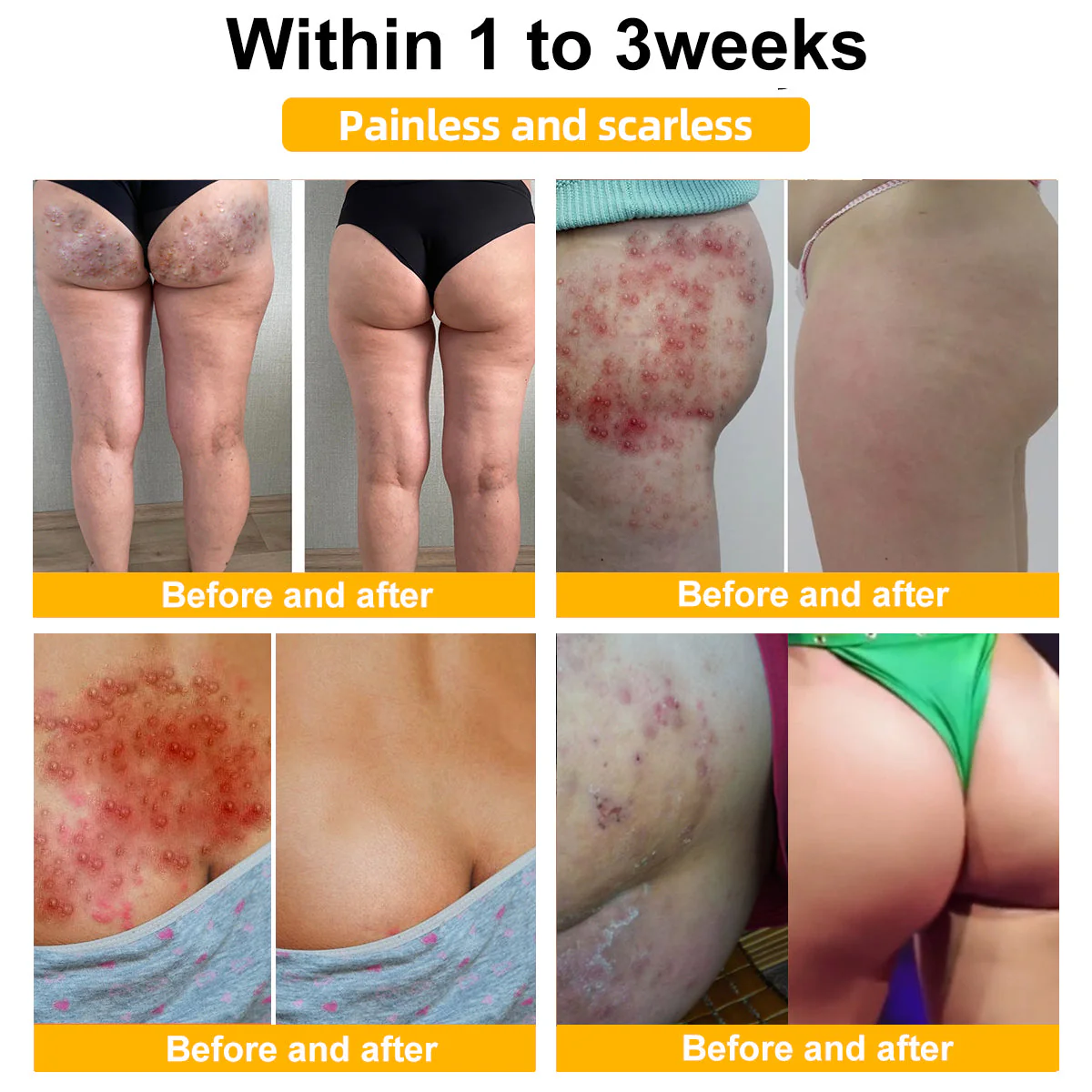 LOVILDS™ Bee Venom Mole and Wart Treatment Cream