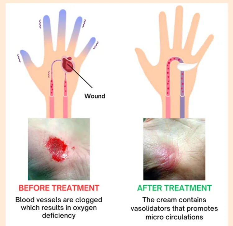LOVILDS™Diabetic Wound Treatment Cream