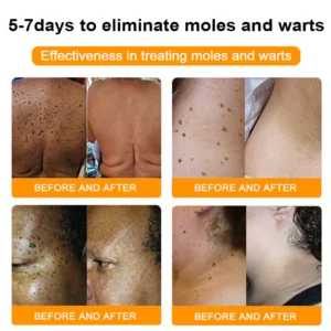ODEIUN™ Bee Venom Tags & Moles Remover