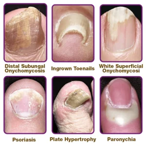 ODEIUN™ FungiFree Bee Venom Nail Treatment Serum