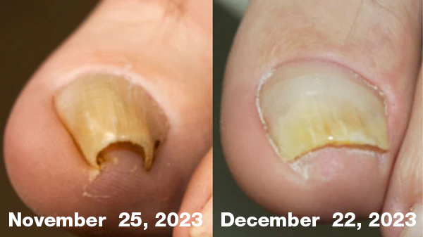 ODEIUN™ FungiFree Bee Venom Nail Treatment Serum 