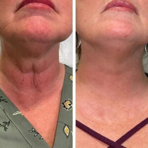 Oveallgo™ SkinFirming Rejuvenating Serum