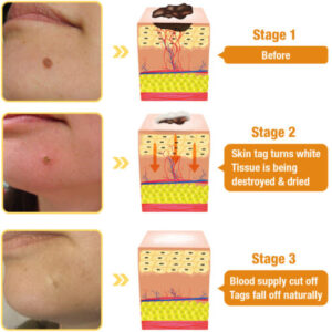 Seurico® Bee Venom Moles and WartsSoothing Serum