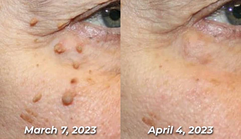 Seurico™ Bee Venom Power Mole & Wart Remover Spray