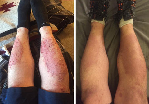 SkinMedix™ Natural Herbaceous Plants Psoriasis Cream