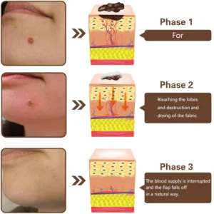 TLOPA™ Bee Venom Wart Removal Treatment Patch