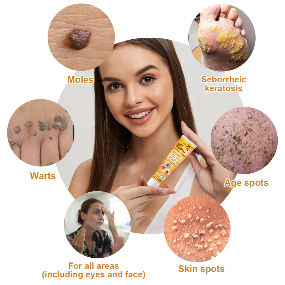 Tiworld™ Bee Venom Wart & Tag Removal Cream