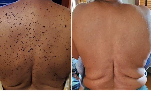 Toclve™ BEE VENOM Wart & Mole Removal Cream