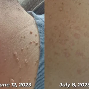 flysmus™ TagRecede Bee Venom Treatment Spray