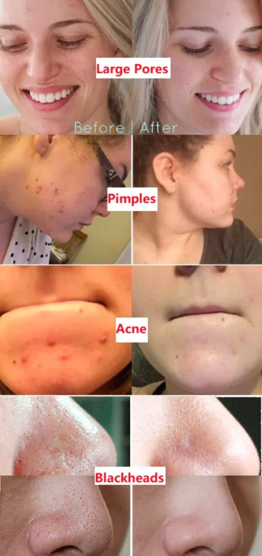 Calendula Peel Off Pack