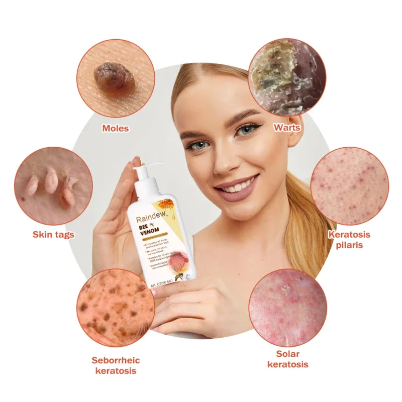 𝗥𝗮𝗶𝗻𝗱𝗲𝘄™ 𝐁𝐞𝐞 𝐕𝐞𝐧𝐨𝐦 𝐌𝐨𝐥𝐞 𝐚𝐧𝐝 𝐖𝐚𝐫𝐭 𝐓𝐫𝐞𝐚𝐭𝐦𝐞𝐧𝐭 𝐂𝐫𝐞𝐚𝐦