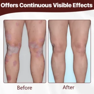 FLYCARE™ Cow’s Fart Eczema Essence
