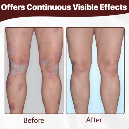 FLYCARE™ Cow’s Fart Eczema Essence