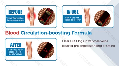 FLYCARE™ Varicose Veins Spray