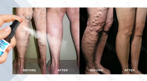FLYCARE™ Varicose Veins Spray