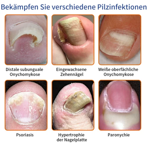 Furzero™ Bee Venom Nail Fungus Treatment Solution