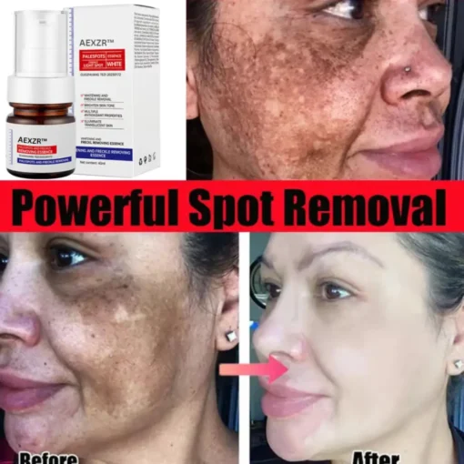AEXZR™ Vitamin C Whitening Freckles Face Cream Remove Melasma Dark Spots Lighten Melanin