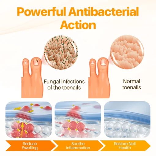 FLYCARE™ Psoriasis Anti-Bacterial Cream
