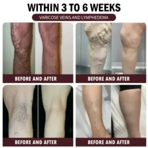𝐀𝐫𝐭𝐡𝐫𝐨𝐅𝐫𝐞𝐞™𝐁𝐞𝐞-𝐕𝐞𝐧𝐨𝐦 𝐏𝐚𝐢𝐧-𝐑𝐞𝐥𝐢𝐞𝐟 𝐁𝐨𝐧𝐞 𝐇𝐞𝐚𝐥𝐢𝐧𝐠 𝐂𝐫𝐞𝐚𝐦