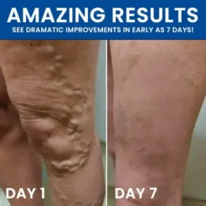 AEXZR™ Varicose Treatment Pill Patch