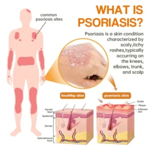 ODALIT™PsoriaHeal psoriasis Spray