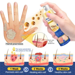 ODALIT™PsoriaHeal psoriasis Spray