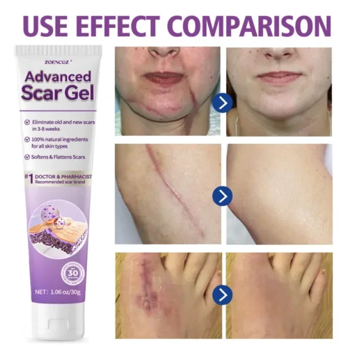 Zoencgz™ Advanced Scar Gel