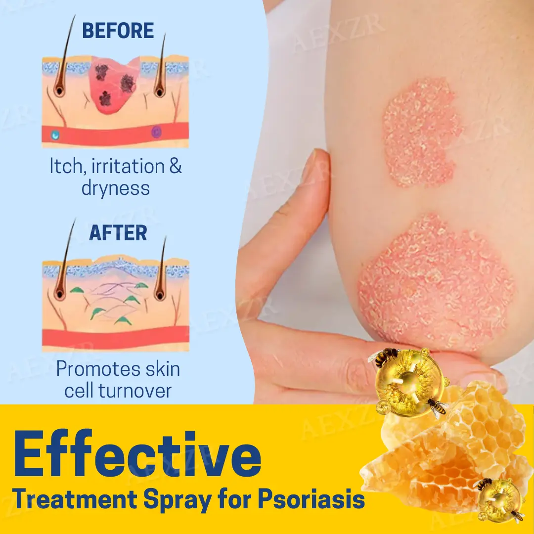 AEXZR™ PsoriaHeal Bee Venom Psoriasis Treatment Spray