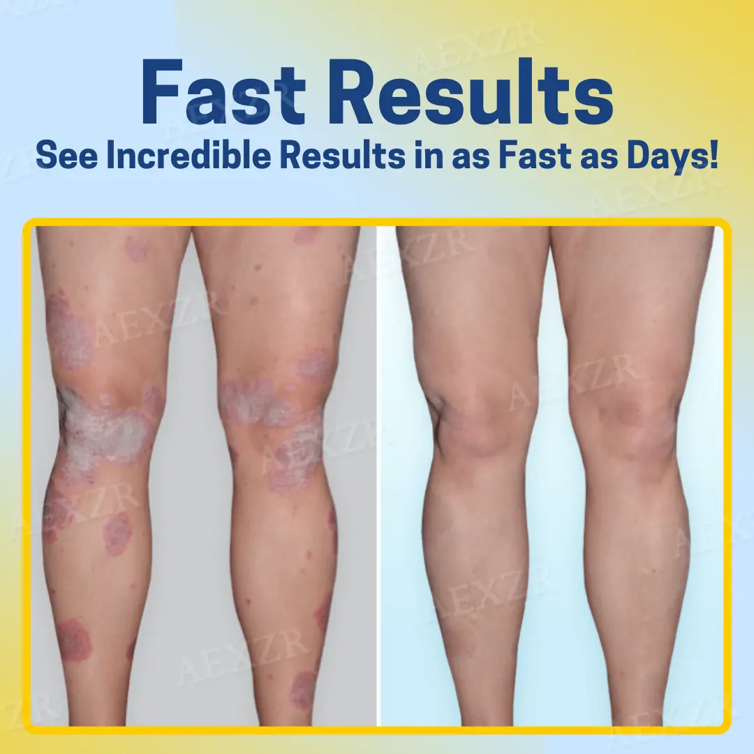 AEXZR™ PsoriaHeal Bee Venom Psoriasis Treatment Spray