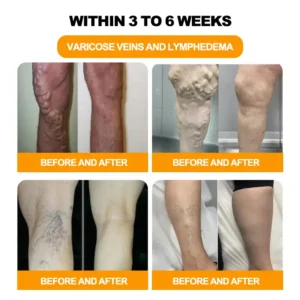 CroAie™ Bee Venom & Herbal Slimming Foot Patches