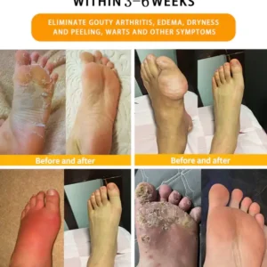 CroAie™ Bee Venom & Herbal Slimming Foot Patches