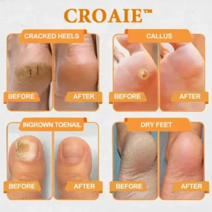 CroAie™ Bee Venom & Herbal Slimming Foot Patches