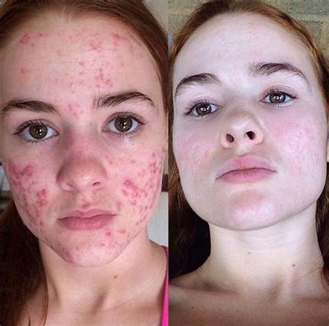 Dobshow™ LuminaHeal Precision Scar Therapy Mist