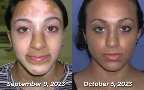 Fivfivgo™ BeeVenom Vitiligo Treatment Cream