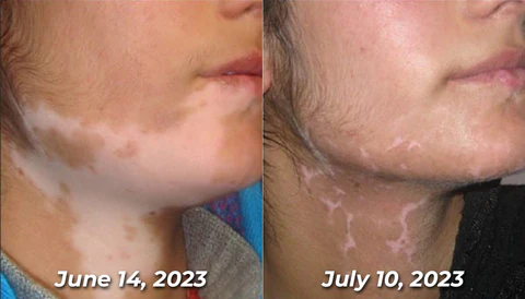 Fivfivgo™ BeeVenom Vitiligo Treatment Cream