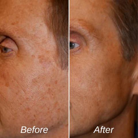 HZA™ Age Spots Removal Patches