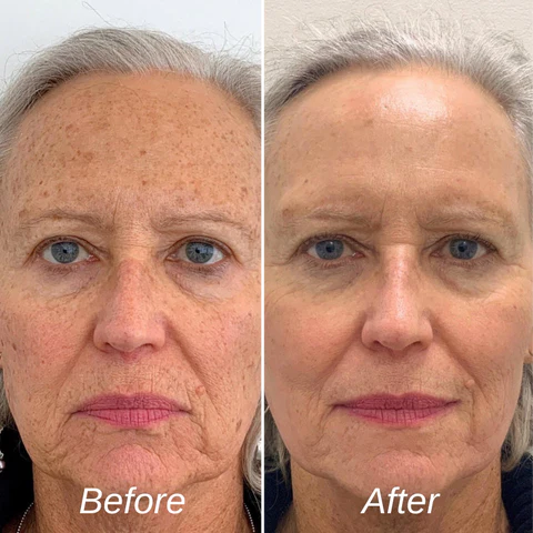 HZA™ Age Spots Removal Patches