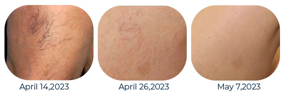 Mucopolysaccharide Polysulfate Cream