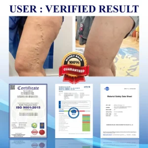 NerviEase™ Ultrasonic Circulation Band